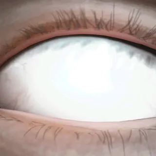 SNOWSPARK LENSES